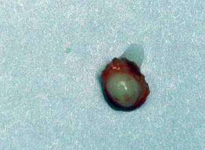 fibroma specimen.jpg